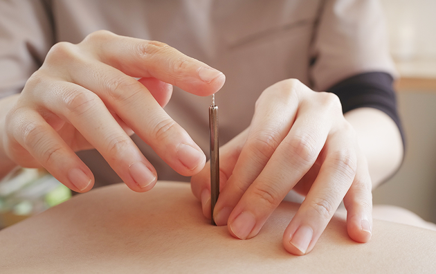 鍼灸治療のイメージ写真